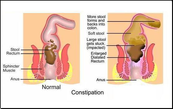 causes of constipation